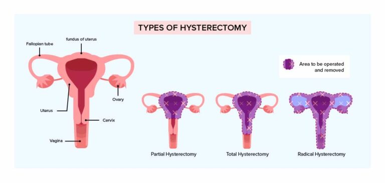 Hysterectomy For Early Cervical Cancer Treatment Happiest Health 9093