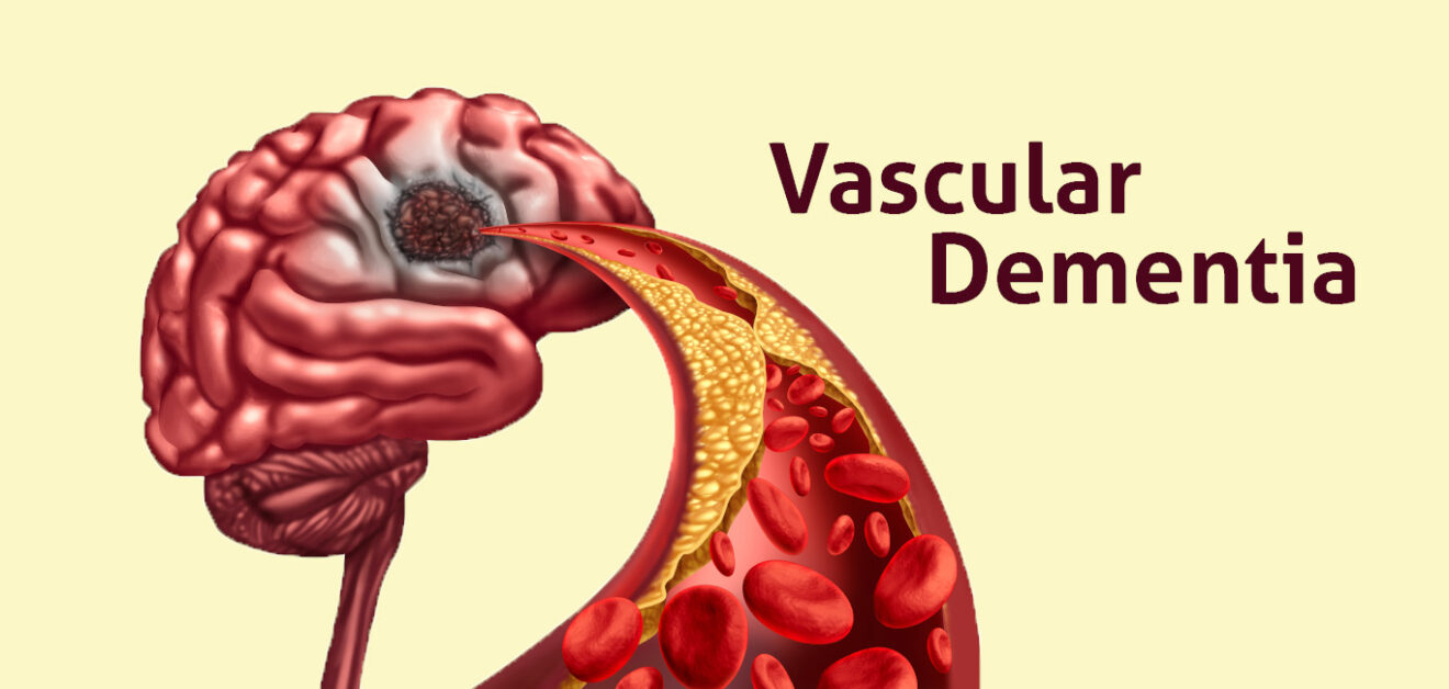 A breathless brain navigating vascular dementia Happiest Health