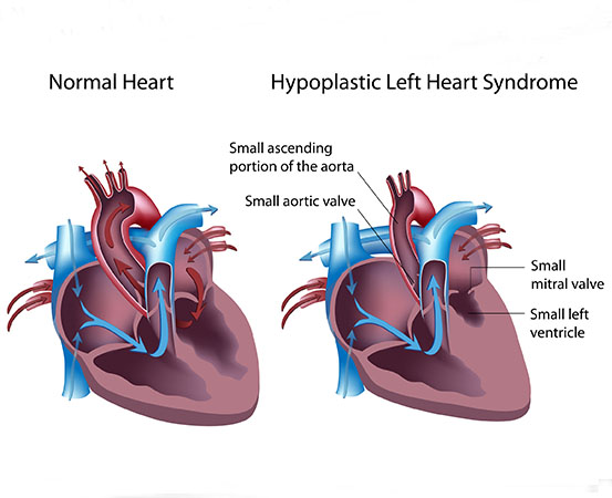 How hypoplastic left heart syndrome cripples a baby’s heart - Happiest ...