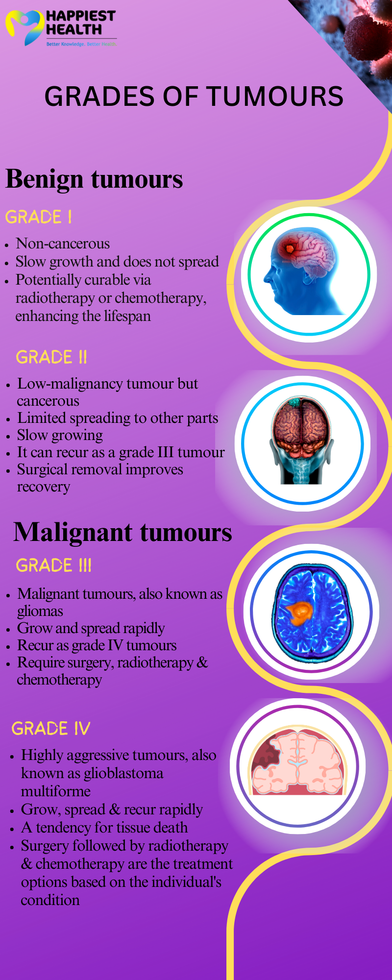 from-low-to-high-grades-of-brain-tumours-happiest-health