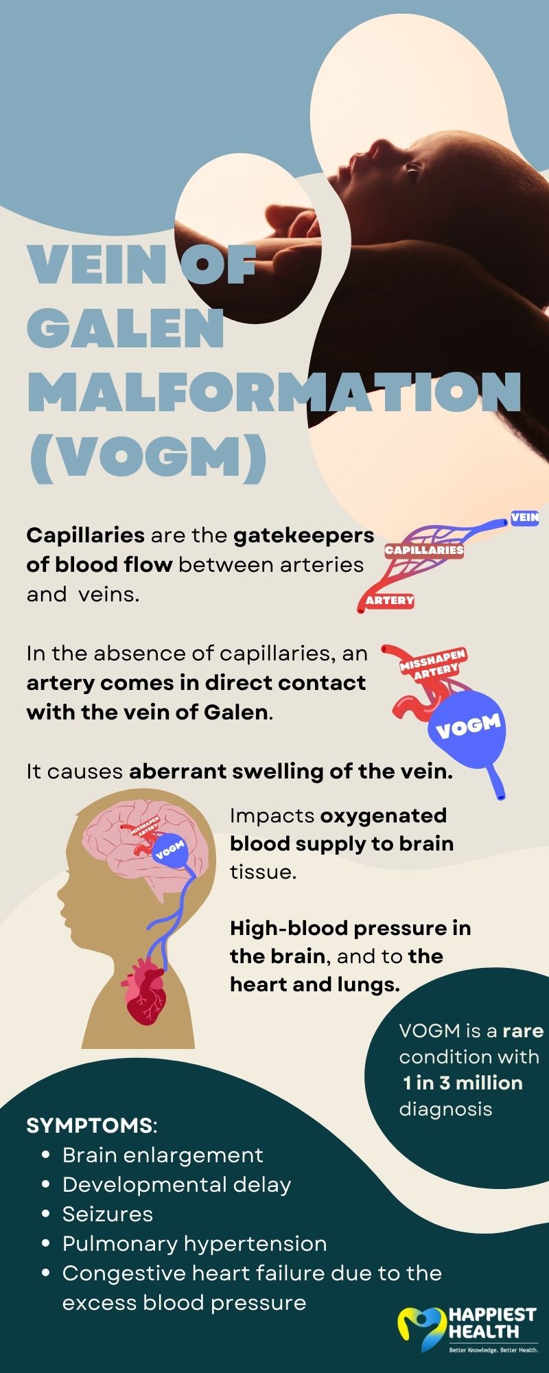 The Vein Of Galen Malformation Vogm Happiest Health