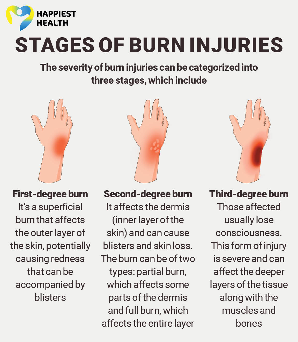 First aid for burns: Ways to minimize injury - Happiest Health