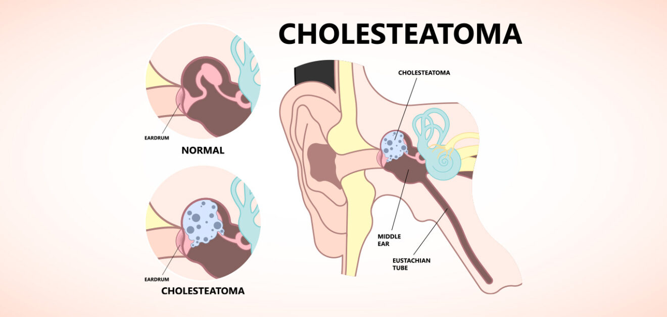 Cholesteatoma and its management - Happiest Health